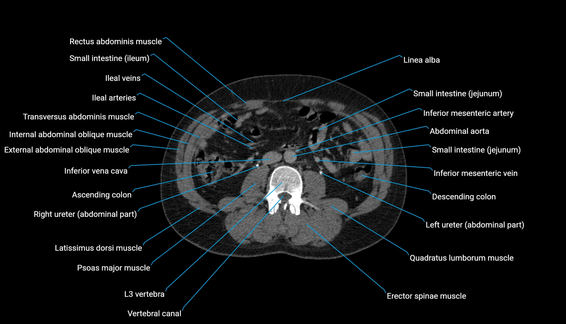 CT urogram axial cross sectional anatomy  labelled radiology image-00131.webp